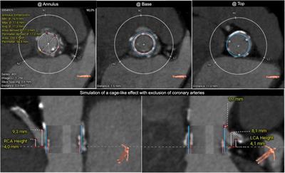 Case Report: Double chimney in valve-in-valve procedures for high-risk coronary obstruction